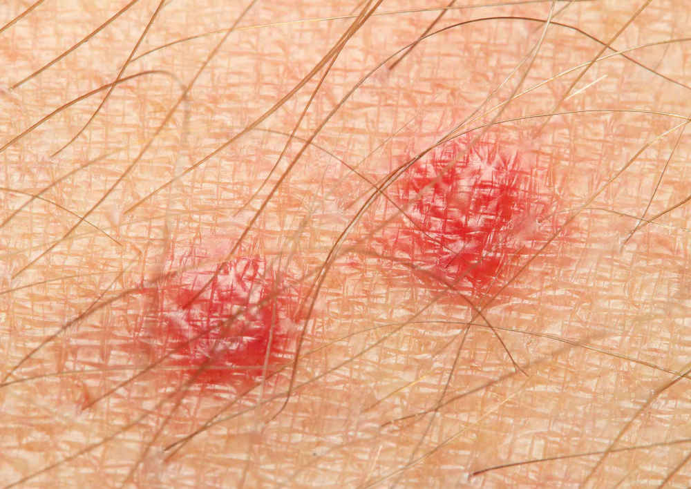 A close up image of two bed bug bites on human skin